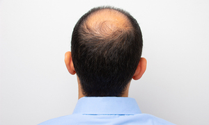 "탈모 건보 적용, 왜 안 되나요?"