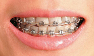 &${esc.h}34;영유아 건강검진 종료 후 교정 상담은 언제 받나&${esc.h}34;