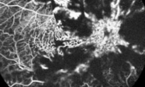 '비아그라' 복용 후 한쪽 눈 실명된 남성