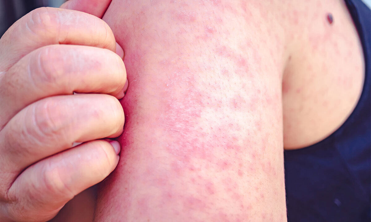 “건강한 내가 왜 홍역 예방 백신 맞아야해? … 임산부·영아·암환자는 백신조차 못맞아 “집단면역의 필요성” 