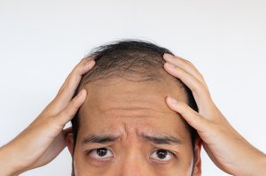 외신도 주목한 탈모 지원…“악명 높은 한국이라면”