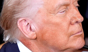 트럼프 오른쪽 목에 붉은 반점… 백악관 "치료제 때문"