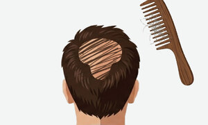 李가 띄운 ‘탈모 지원’ 지자체 속속 가세